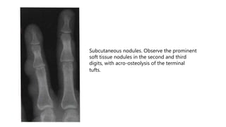 Subcutaneous nodules. Observe the prominent
soft tissue nodules in the second and third
digits, with acro-osteolysis of the terminal
tufts.
 