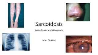 Sarcoidosis
in 6 minutes and 40 seconds
Matt Dickson
 