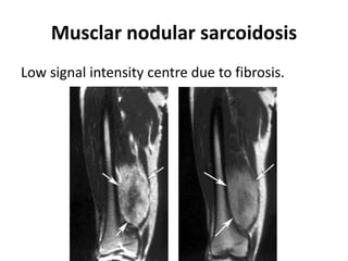 Musclar nodular sarcoidosis
Low signal intensity centre due to fibrosis.
 