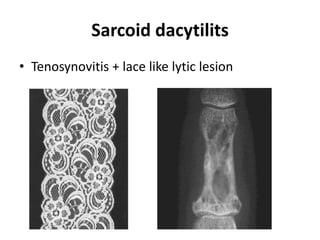 Sarcoid dacytilits
• Tenosynovitis + lace like lytic lesion
 