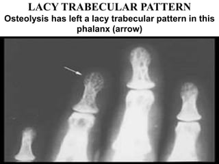 LACY TRABECULAR PATTERN
Osteolysis has left a lacy trabecular pattern in this
phalanx (arrow)
 