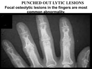 PUNCHED OUT LYTIC LESIONS
Focal osteolytic lesions in the fingers are most
common abnormality.
 