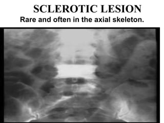 SCLEROTIC LESION
Rare and often in the axial skeleton.
 