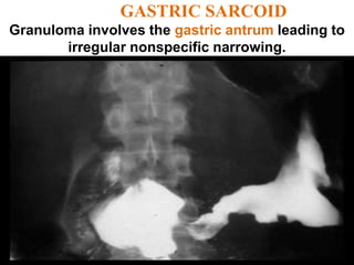 GASTRIC SARCOID
Granuloma involves the gastric antrum leading to
irregular nonspecific narrowing.
 