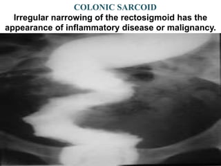 COLONIC SARCOID
Irregular narrowing of the rectosigmoid has the
appearance of inflammatory disease or malignancy.
 