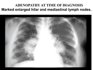 ADENOPATHY AT TIME OF DIAGNOSIS
Marked enlarged hilar and mediastinal lymph nodes.
 