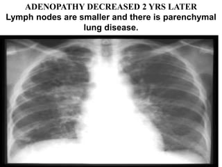 ADENOPATHY DECREASED 2 YRS LATER
Lymph nodes are smaller and there is parenchymal
lung disease.
 