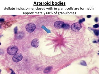 Asteroid bodies
stellate inclusion enclosed with in giant cells are formed in
approximately 60% of granulomas
 
