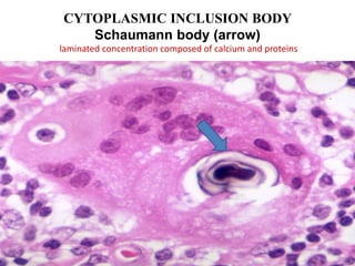 CYTOPLASMIC INCLUSION BODY
Schaumann body (arrow)
laminated concentration composed of calcium and proteins
 