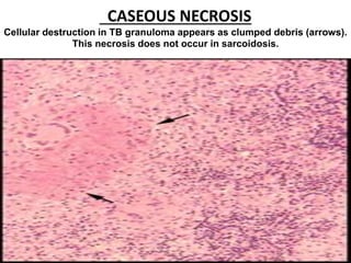 CASEOUS NECROSIS
Cellular destruction in TB granuloma appears as clumped debris (arrows).
This necrosis does not occur in sarcoidosis.
 