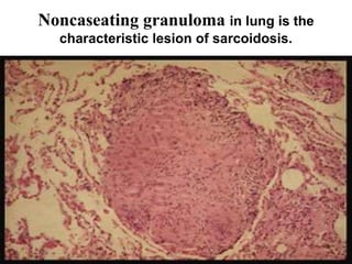 Noncaseating granuloma in lung is the
characteristic lesion of sarcoidosis.
 