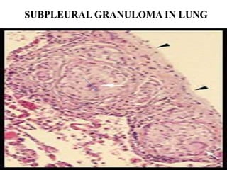 SUBPLEURAL GRANULOMA IN LUNG
 