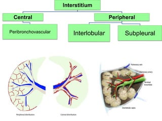 Interstitium
Central
Peribronchovascular
Peripheral
Interlobular Subpleural
 