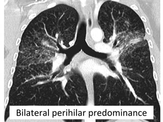 Bilateral perihilar predominance
 