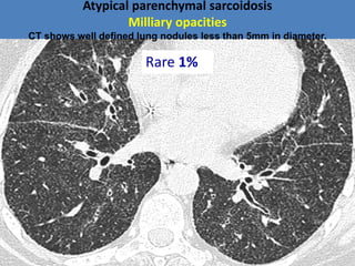 Atypical parenchymal sarcoidosis
Milliary opacities
CT shows well defined lung nodules less than 5mm in diameter.
Rare 1%
 