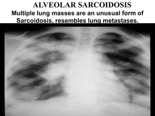 ALVEOLAR SARCOIDOSIS
Multiple lung masses are an unusual form of
Sarcoidosis, resembles lung metastases.
 