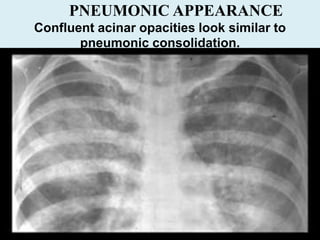 PNEUMONIC APPEARANCE
Confluent acinar opacities look similar to
pneumonic consolidation.
 