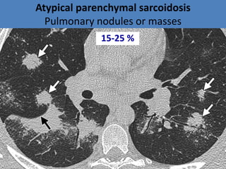 Atypical parenchymal sarcoidosis
Pulmonary nodules or masses
15-25 %
 