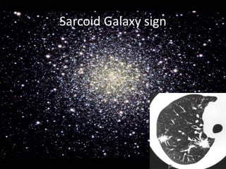 Sarcoid Galaxy sign
 