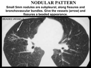 NODULAR PATTERN
Small 5mm nodules are subpleural, along fissures and
bronchovascular bundles. Give the vessels (arrow) and
fissures a beaded appearance.
 