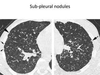 Sub-pleural nodules
 