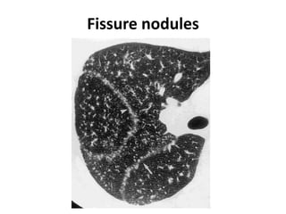 Fissure nodules
 