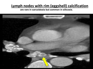 Lymph nodes with rim (eggshell) calcification
are rare in sarcoidosis but common in silicosis.
 