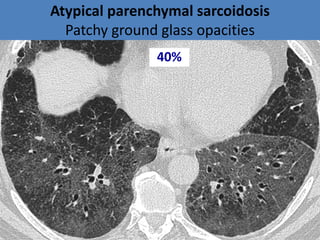 Atypical parenchymal sarcoidosis
Patchy ground glass opacities
40%
 