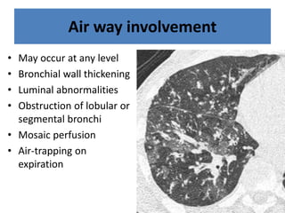 Air way involvement
• May occur at any level
• Bronchial wall thickening
• Luminal abnormalities
• Obstruction of lobular or
segmental bronchi
• Mosaic perfusion
• Air-trapping on
expiration
 