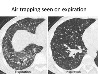 Air trapping seen on expiration
 