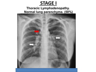 STAGE I
Thoracic Lymphadenopathy.
Normal lung parenchyma. (50%)
 