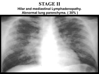 STAGE II
Hilar and mediastinal Lymphadenopathy.
Abnormal lung parenchyma. ( 30% )
 