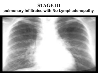 STAGE III
pulmonary infiltrates with No Lymphadenopathy.
 