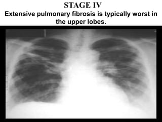 STAGE IV
Extensive pulmonary fibrosis is typically worst in
the upper lobes.
 