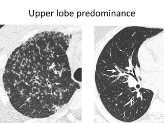Upper lobe predominance
 