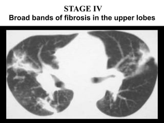 STAGE IV
Broad bands of fibrosis in the upper lobes
 