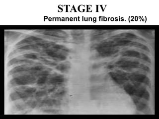STAGE IV
Permanent lung fibrosis. (20%)
 