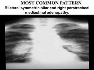 MOST COMMON PATTERN
Bilateral symmetric hilar and right paratracheal
mediastinal adenopathy.
 