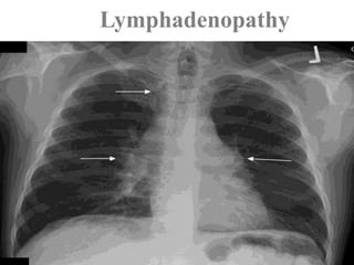 Lymphadenopathy
 