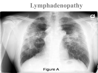 Lymphadenopathy
 