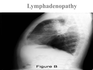 Lymphadenopathy
 