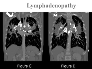 Lymphadenopathy
 