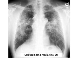 Calcified hilar & mediastinal LN
 