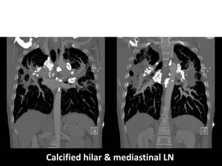 Calcified hilar & mediastinal LN
 