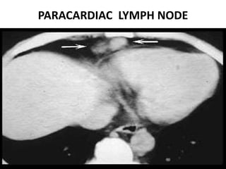 PARACARDIAC LYMPH NODE
 