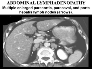 ABDOMINAL LYMPHADENOPATHY
Multiple enlarged paraaortic, paracaval, and porta
hepatis lymph nodes (arrows).
 