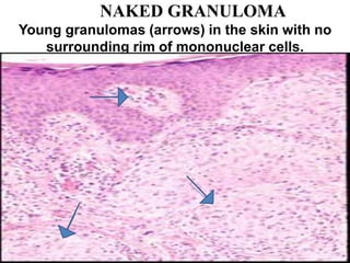 NAKED GRANULOMA
Young granulomas (arrows) in the skin with no
surrounding rim of mononuclear cells.
 