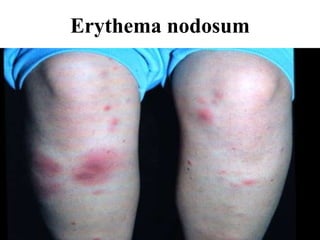 Erythema nodosum
 