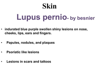 Skin
Lupus pernio- by besnier
• indurated blue purple swollen shiny lesions on nose,
cheeks, lips, ears and fingers.
• Papules, nodules, and plaques
• Psoriatic like lesions
• Lesions in scars and tattoos
 