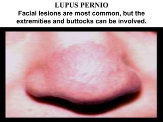 LUPUS PERNIO
Facial lesions are most common, but the
extremities and buttocks can be involved.
 